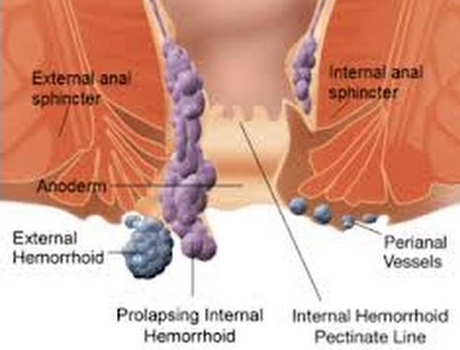 thrombosed hemorrhoids